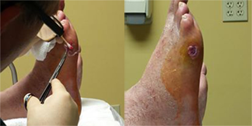 skin-graft-composite